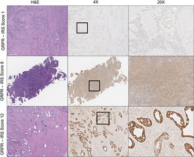 Human gastrin- releasing peptide receptor expression in women with uterine cervix cancer